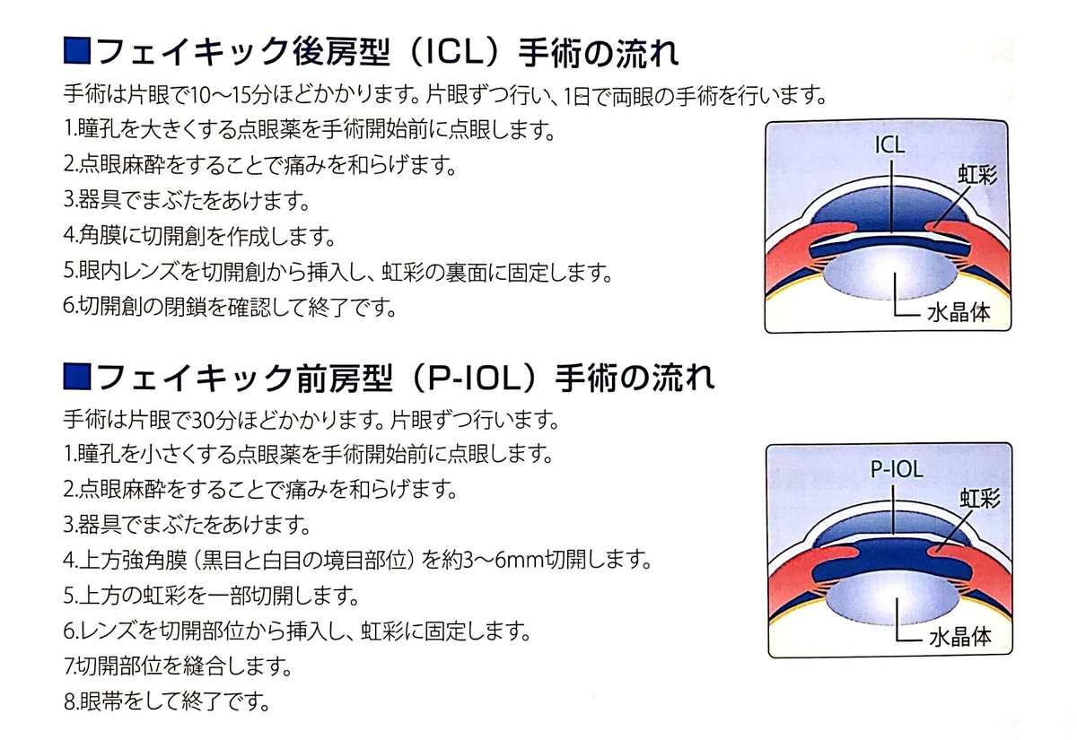 視力回復のための選択肢 Icl手術とは すぴかの手術体験記