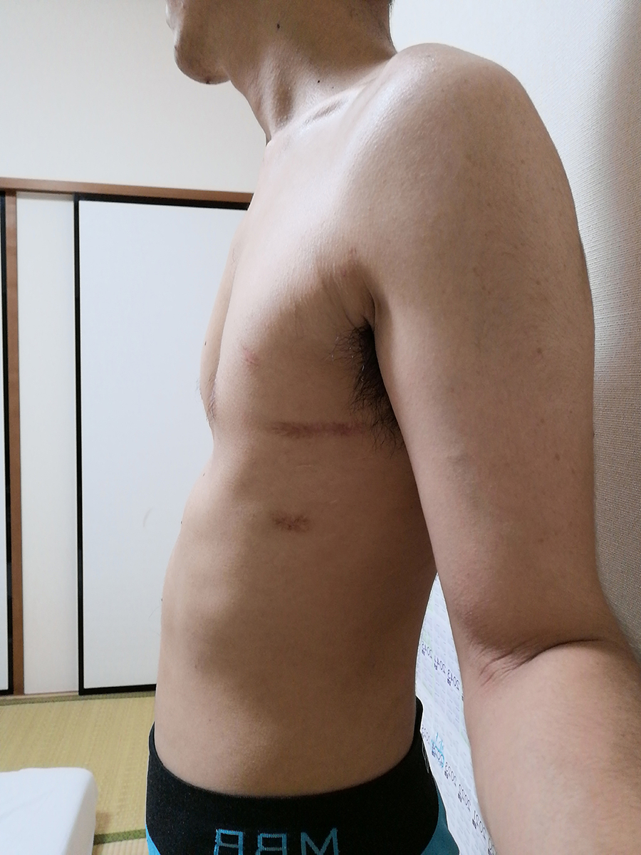 2019年9月6日時点の身体の写真（横）
