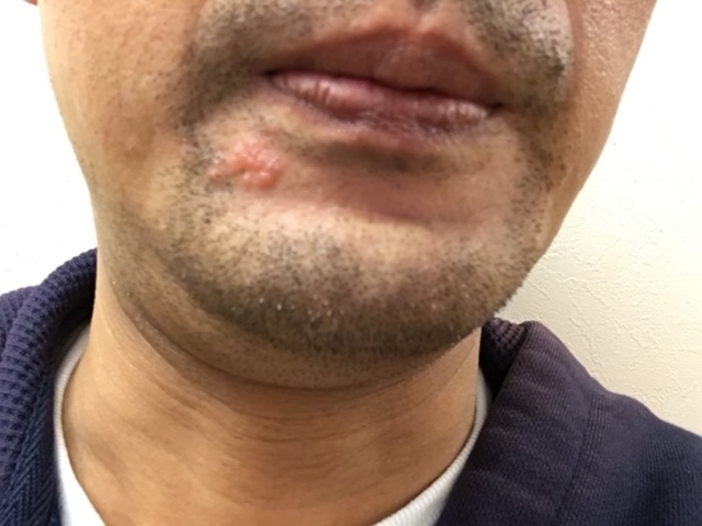 唇と口内炎の症状