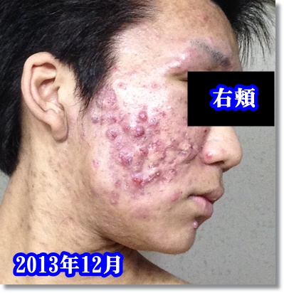 アトピーをバカにしてる人へ これを見てもひどいこと言えるんですか 無断転載禁止 C 2ch Net