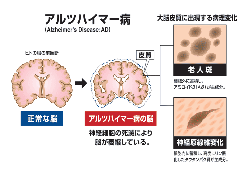 アルツハイマー病とは何ですか?