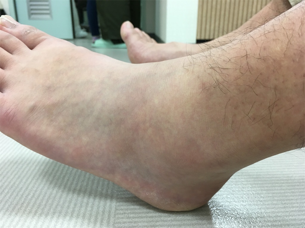 帰国後 痛風 を発症 その言い訳を考えてみる Cikarang