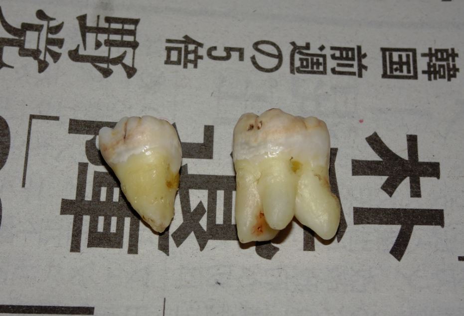 2016 11 20 親知らずを抜歯した際の空気漏れ体験 Seacucumberの日記