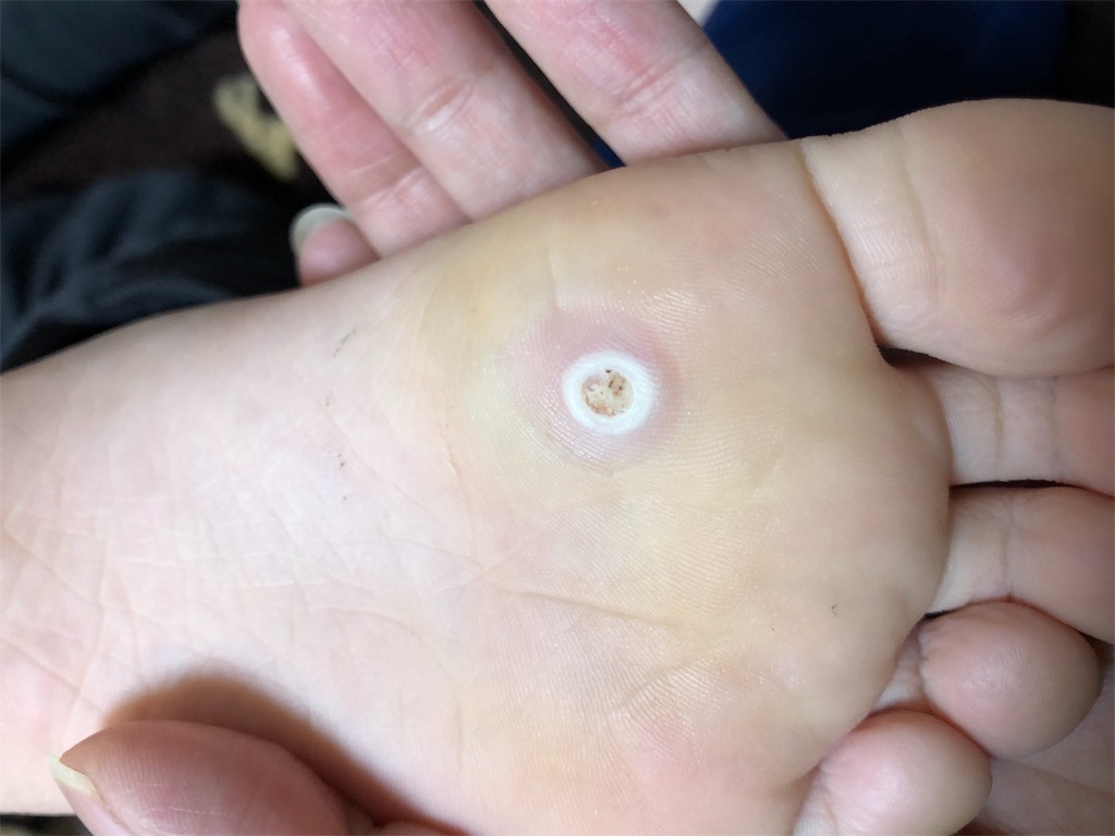 子供の ウイルス性イボ 自宅治療 ティーツリーオイル 主婦のすゝめ