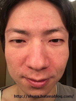 酒さ様皮膚炎が治るまで