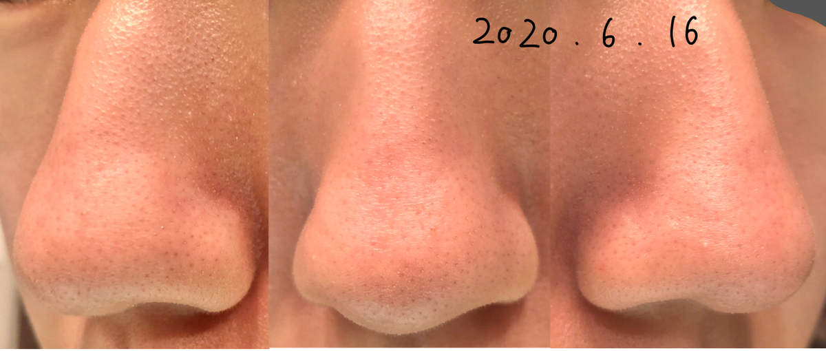 毛穴セラピストの肌断食記録