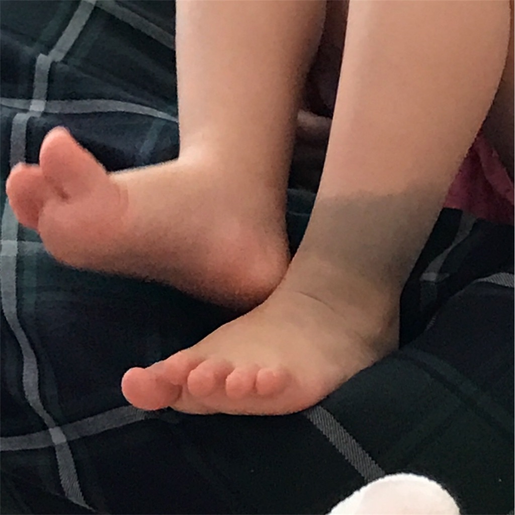 異所性蒙古斑 くもり ときどき はれ