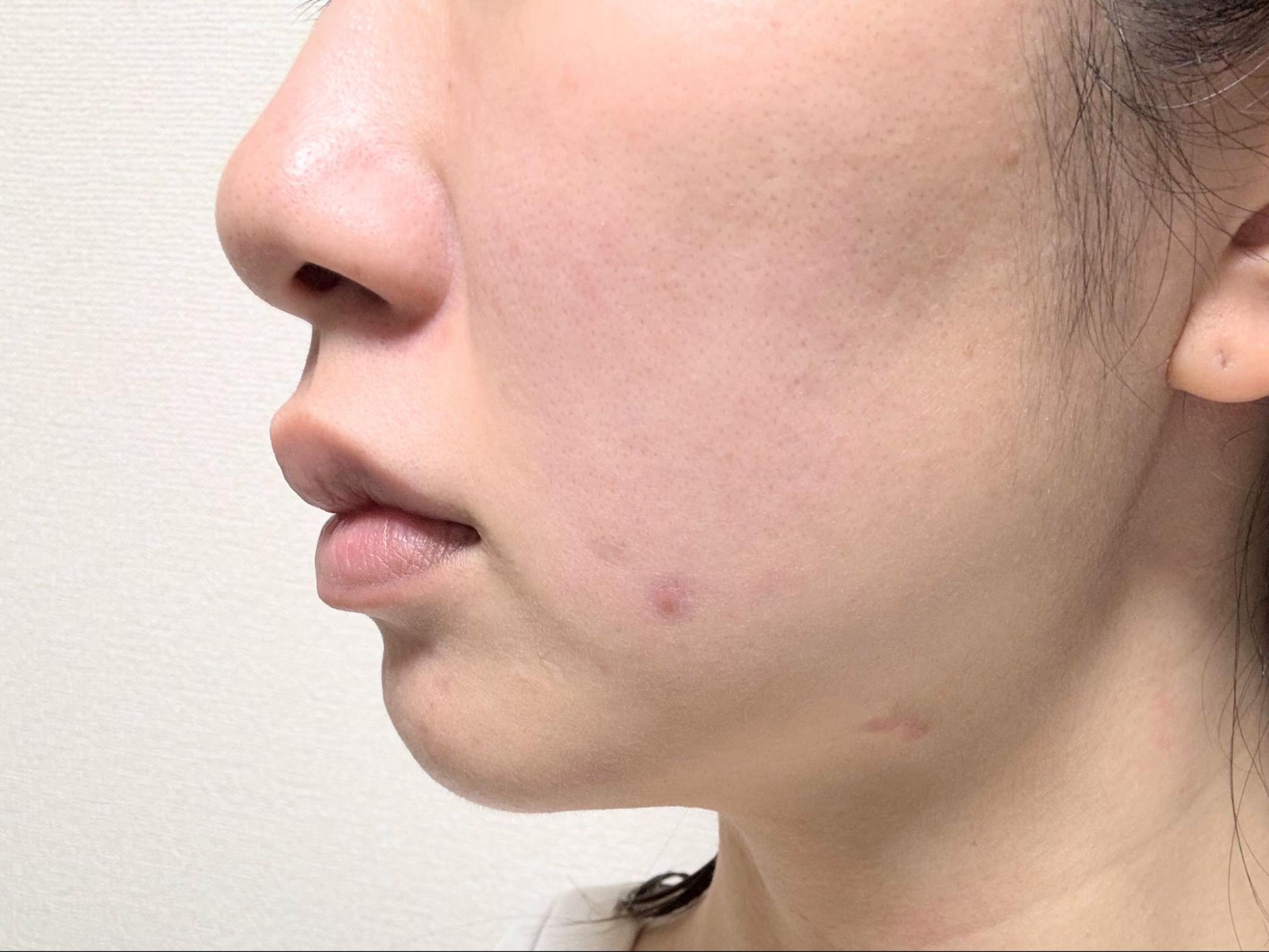 1日目の肌。毛穴や赤みが気になる…