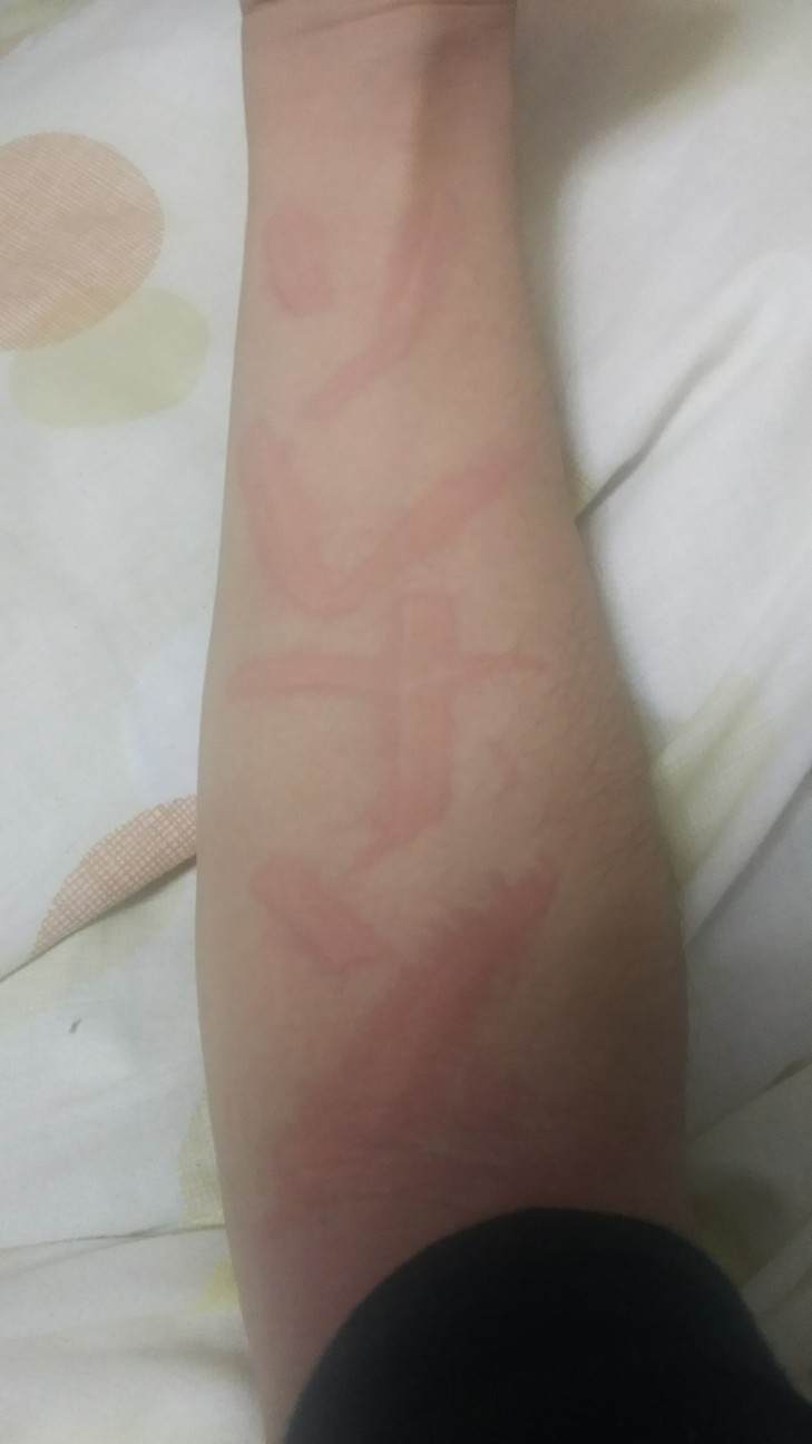 蕁麻疹がすぐに出る 赤色皮膚描記症 Red Dermatitis とは何かを私が身体を張って紹介してやる みみず腫れアート作品描けそうですわ 食べ歩きまくる難病アトピー性脊髄炎ブログ Intractable Disease Atopic Transverse Myelitis Blog