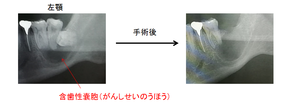濾胞性嚢胞の症状は何ですか?