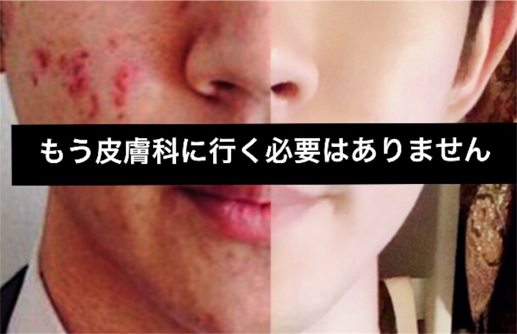 美しい ドテラ ニキビ 500 トップ画像 Hd