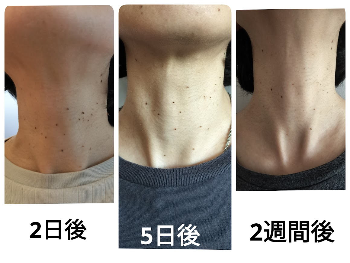 液体窒素処置後の状態