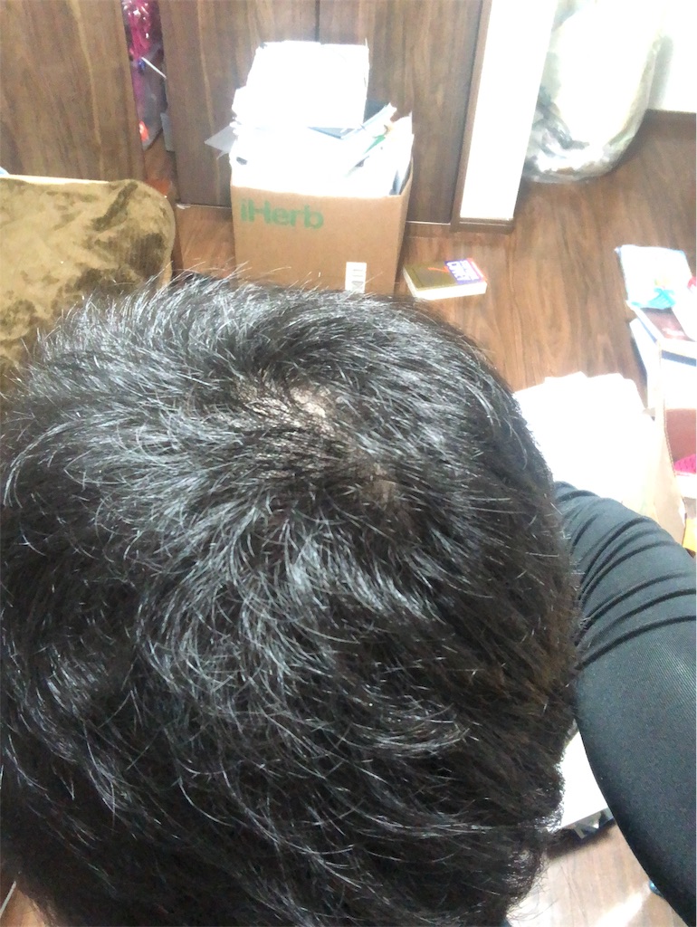 薄毛 ランニング 効果 薄毛 ランニング 効果