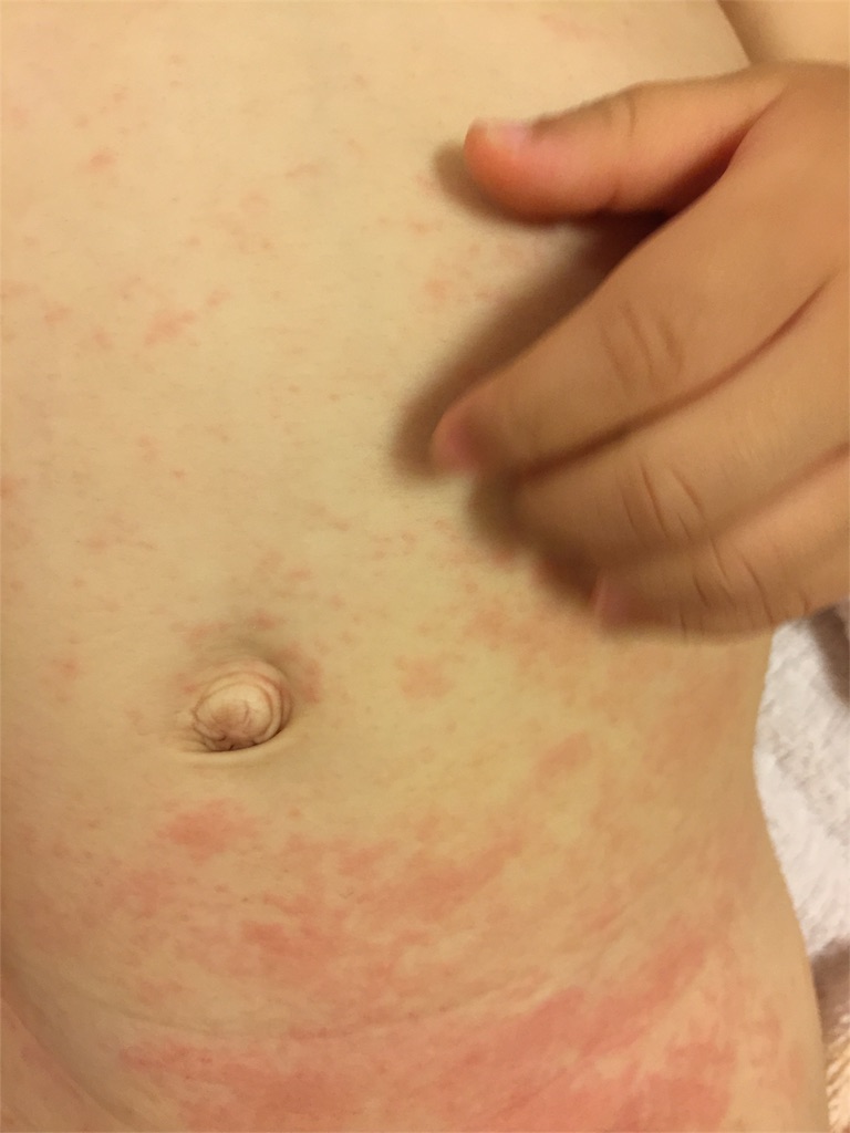 溶連菌 解熱して安心 ではなかった ママは大変 子育て満点じゃなくても