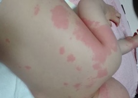 2歳2か月 多形滲出性紅斑で入院になるまでのこと 猫の手も借りたい 高齢ママの育児日記