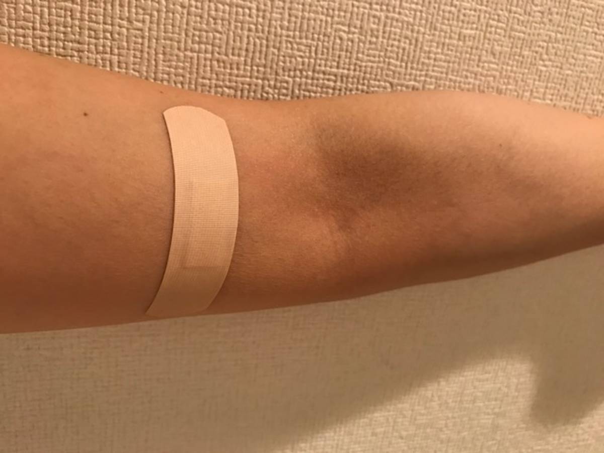 アルコールパッチテストやり方！自分で自宅で簡単にできる！ 下戸でも酒に強くなる方法！坂上太一ネタバレ！