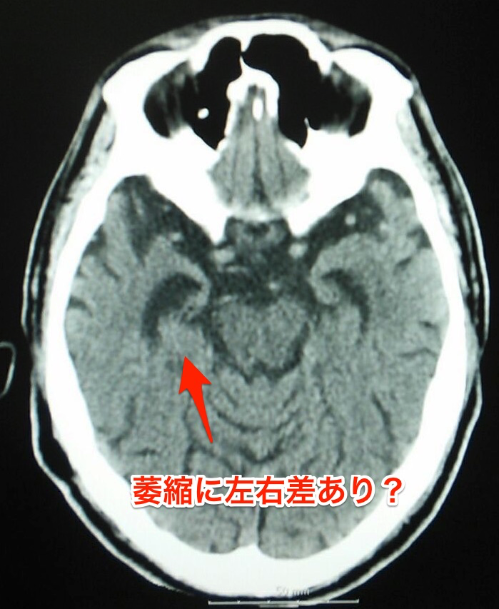 アルツハイマーか前頭側頭葉変性症か