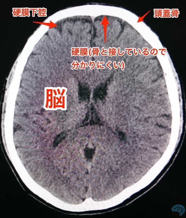 硬膜下腔のCT