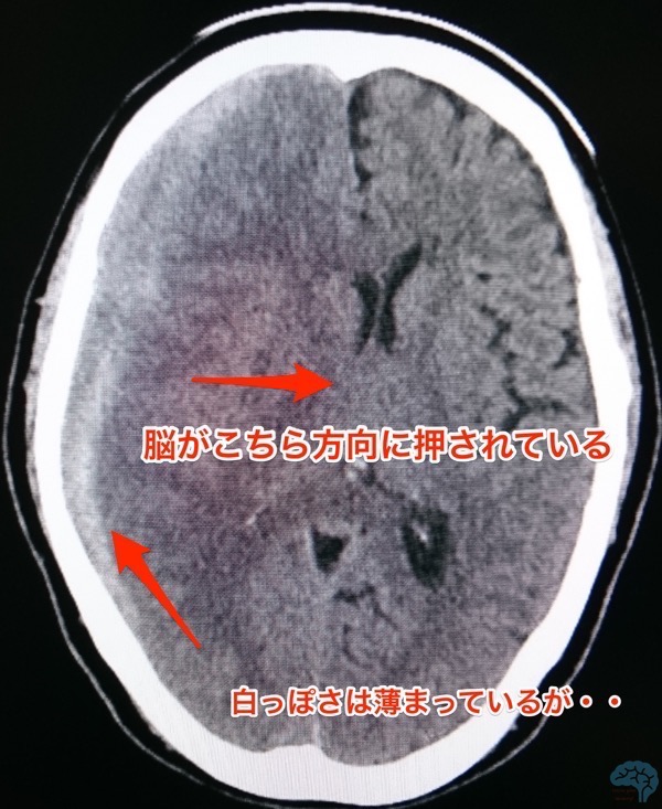 脳ヘルニア、正中偏倚、頭部CT