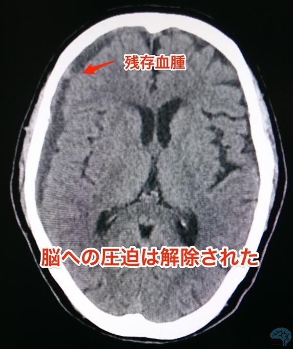 急性硬膜下血腫に対する術後2週間目の改善CT