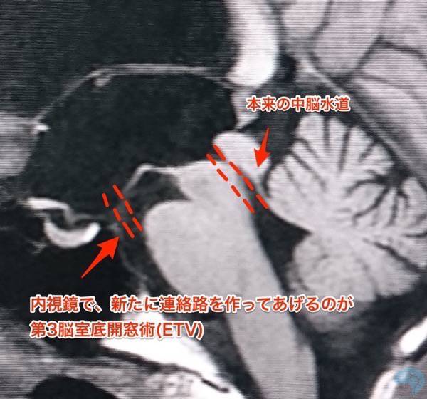 ETVで開窓する場所は灰白隆起