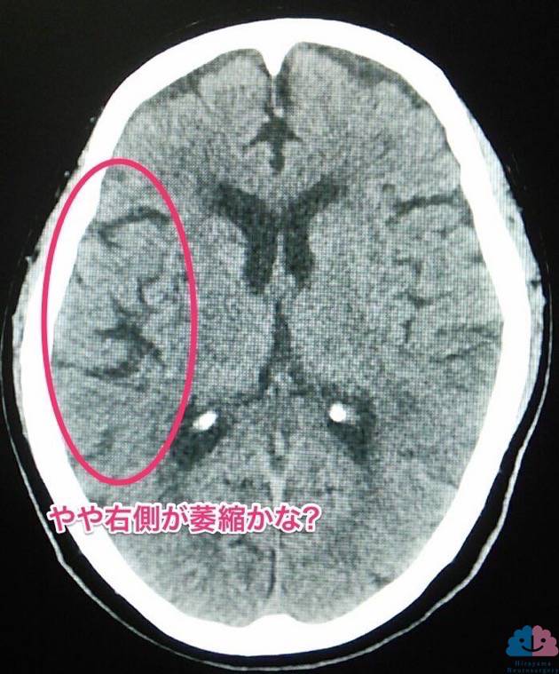 クロイツフェルト・ヤコブ病の頭部CT、萎縮の左右差有り?