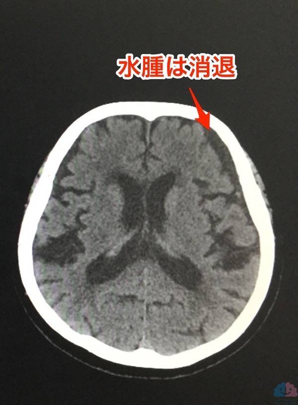 硬膜下水腫が五苓散で改善したCT