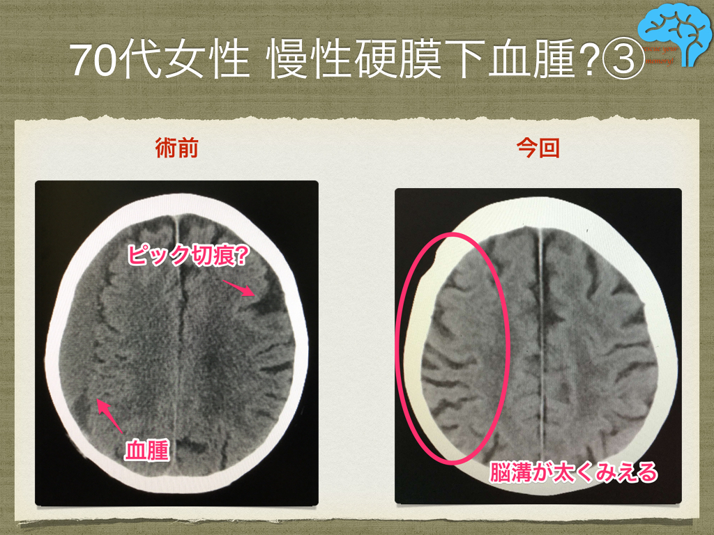 慢性硬膜下血腫の術前術後、ピック切痕と中心溝近傍の脳溝拡大
