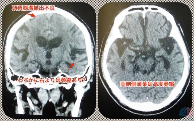 LPC+iNPHの頭部画像