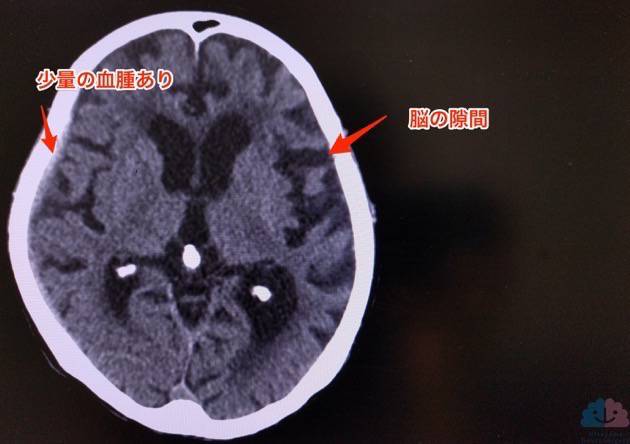 少量の急性硬膜下血腫