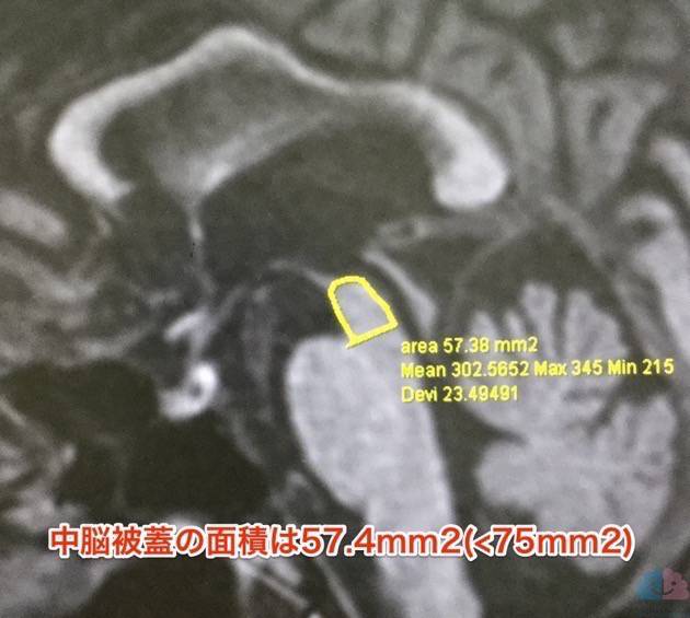 橋被蓋の面積