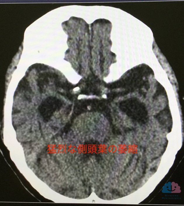 頭部CTで両側側頭葉内側の萎縮