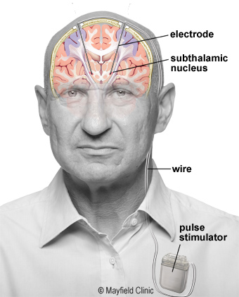 DBS(脳深部刺激療法)