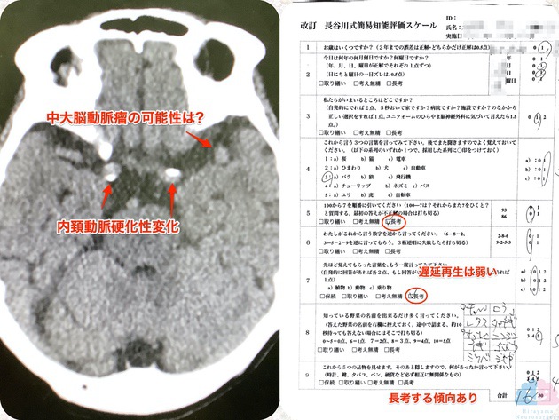 脳血管性認知症