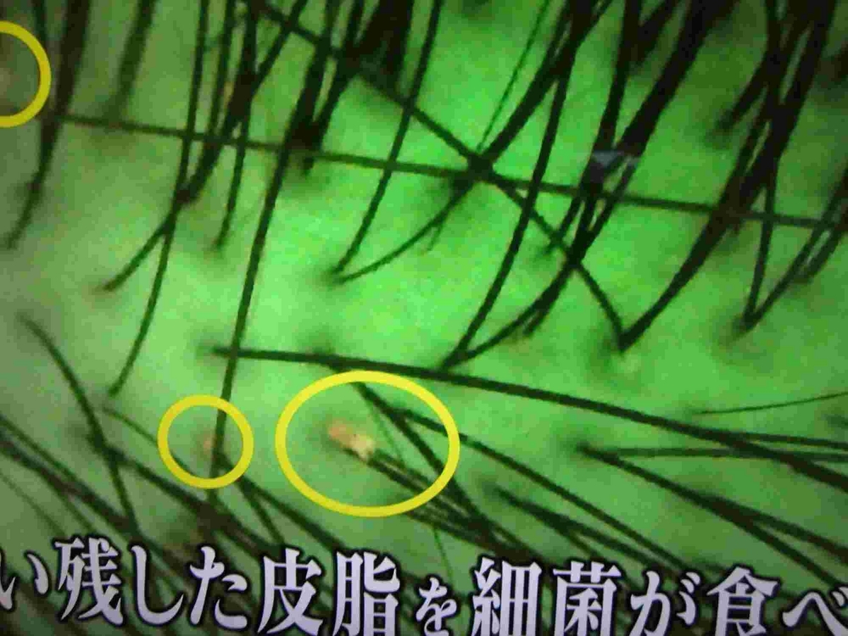 あさイチ・頭皮のセルフチェック