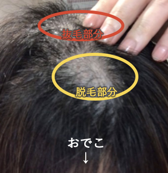 副作用で抜けたのは自分では抜かない前髪部分。奥のてっぺんは自分で抜いた意識ありの抜毛部分。勝手に抜けると肌の色が白いんだなぁしみじみ。