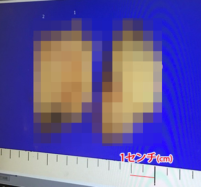 モザイクver摘出したタローの悪性脳腫瘍(膠芽腫)のアワビ写真(おい;