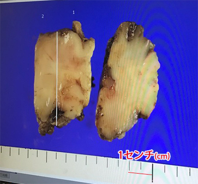 摘出したタローの悪性脳腫瘍(膠芽腫)の写真