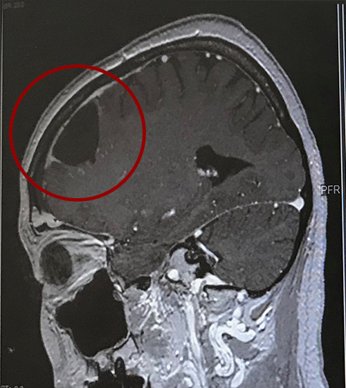 退院前日2020年10月14日撮影の脳CT写真(赤い丸が腫瘍部分切除)