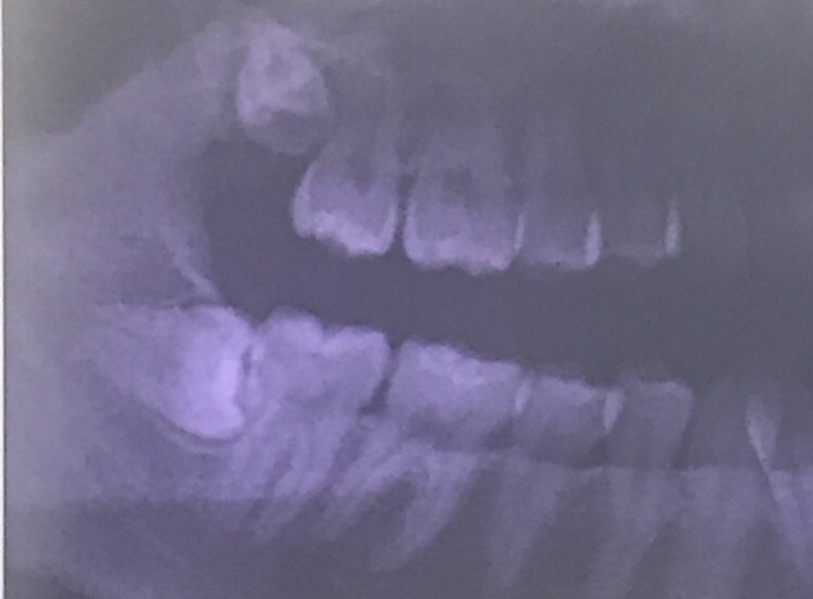 f:id:tatakauolchan:20180826201144j:plain f:id:tatakauolchan:20180826201144j:plain