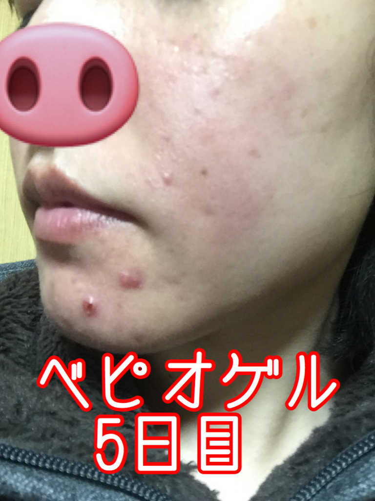 ニキビの治療日記