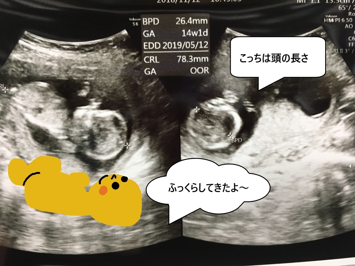 エコー写真の見方と推移 お茶充生活 エコー写真の見方と推移 お茶充生活