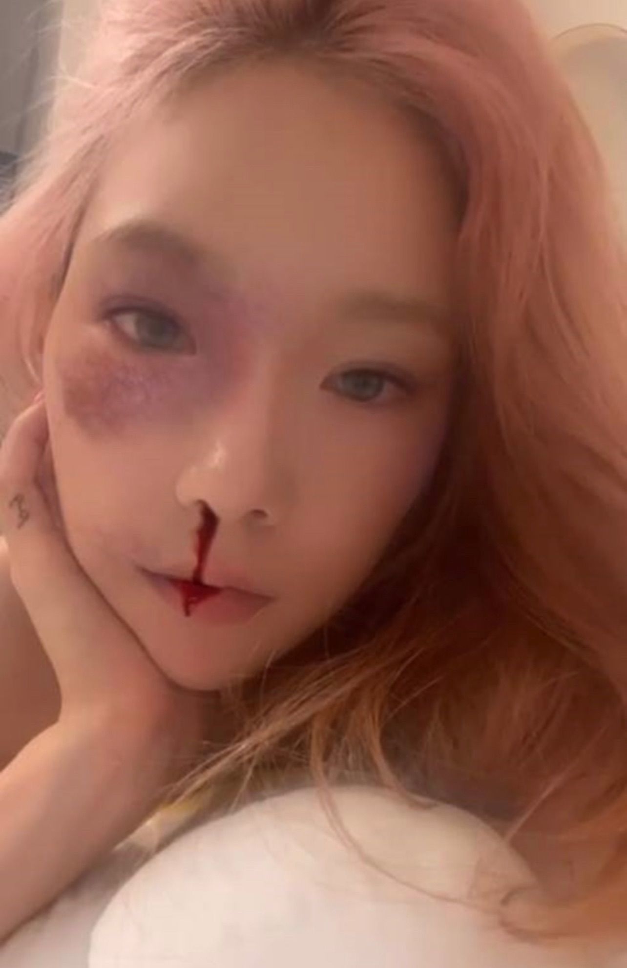 ファンびっくり 少女時代テヨン インスタグラムで目の周りにあざ 鼻血姿を公開 韓information ファンびっくり 少女時代テヨン インスタグラムで目の周りにあざ 鼻血姿を公開 韓information