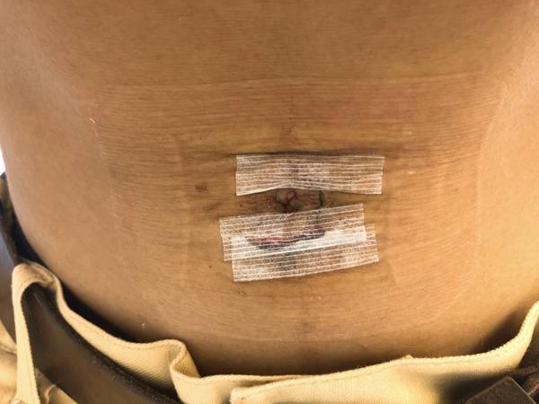手術後３日目のおなかの写真