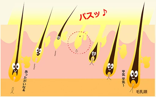 ハイパースキン脱毛の説明図