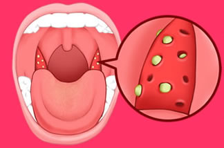 B 臭い玉 膿栓 のグロい画像よりイラストで解説 取り方にも注意 臭い玉 膿栓 と舌苔が口臭の原因
