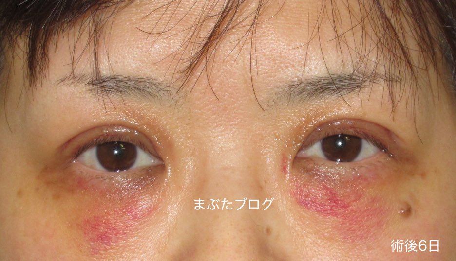 巨大乳頭結膜炎 よくある目の病気 20 京橋クリニック眼科 大阪市都島区京橋駅前の眼科専門のクリニック