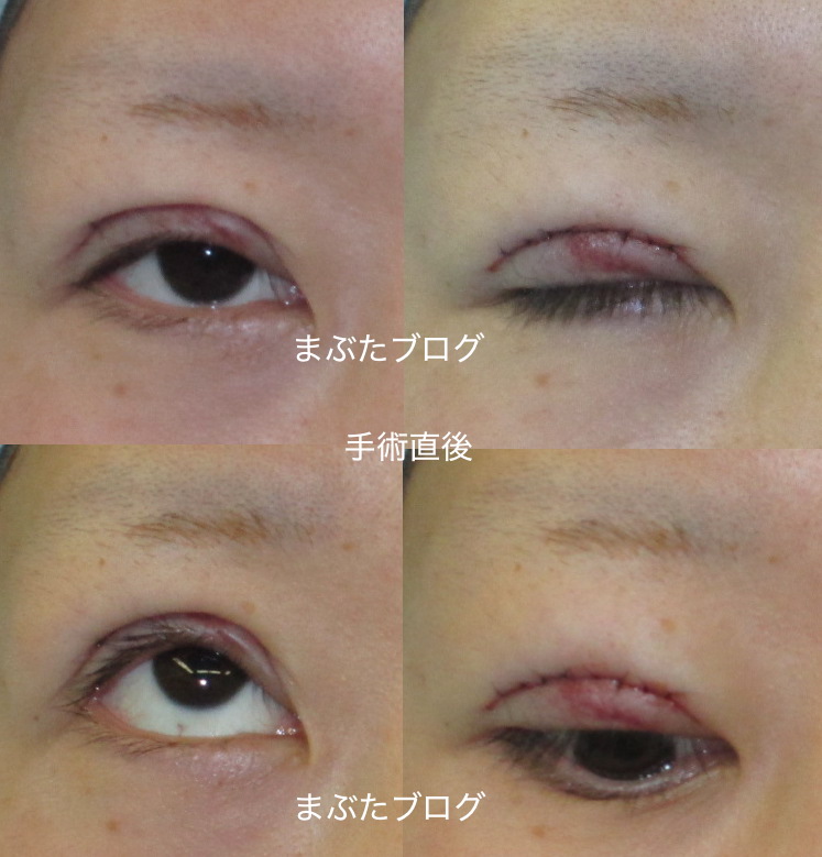 埋没後の全切開と挙筋前転術 先天性眼瞼下垂 代女性 経過とダウンタイム 王子のまぶたブログ 眼瞼下垂と二重