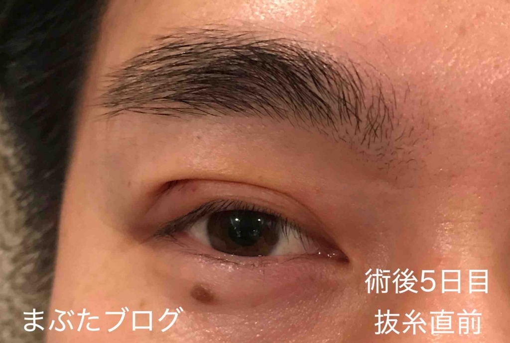 した まぶた が 痛い