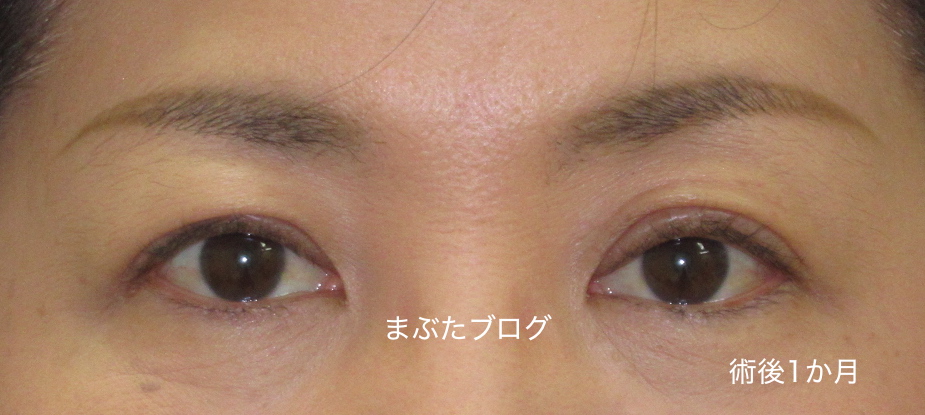 年前の自分に戻す眼瞼下垂症手術 術後経過とダウンタイム 50代女性 続き 王子のまぶたブログ 眼瞼下垂と二重